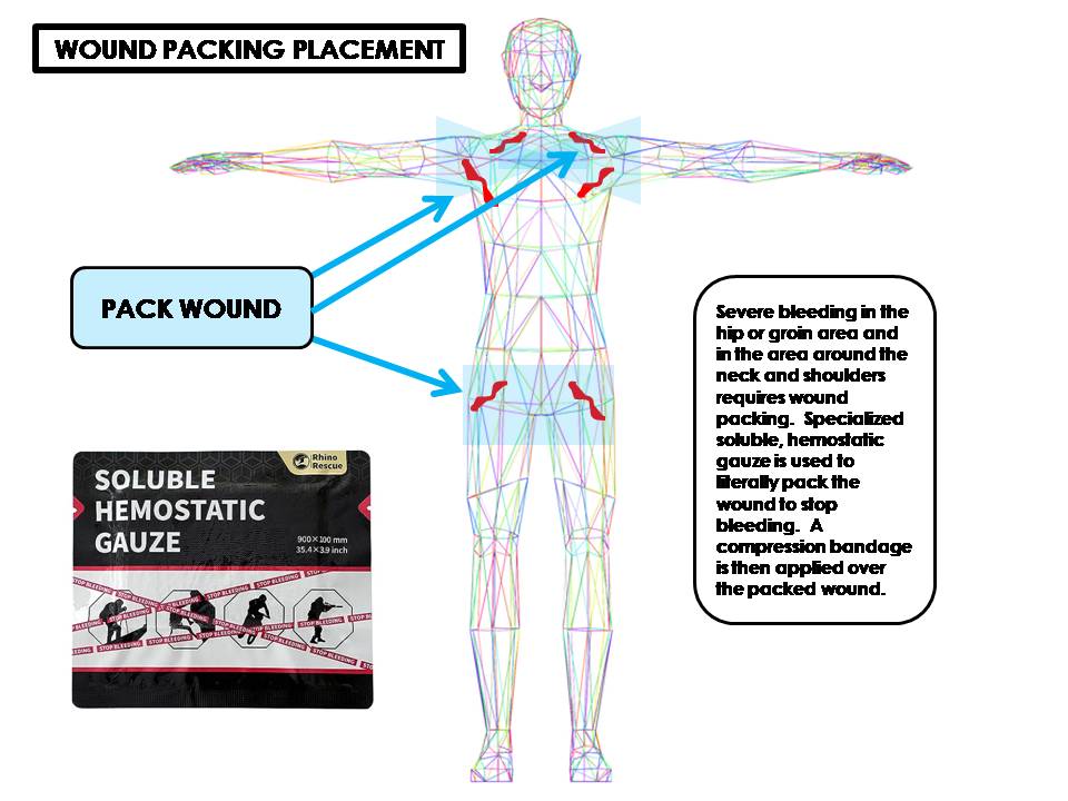 WOUND PACKING GUIDELINES