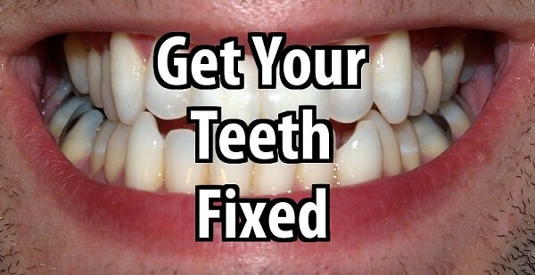 Why You Should Get Your Teeth Fixed
