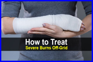 How to Treat Severe Burns Off-Grid