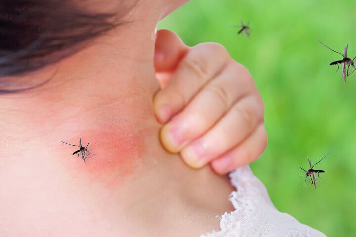 Mosquito Bite On Skin