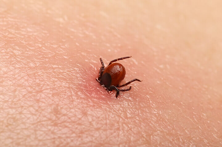 Tick Digging Into Skin