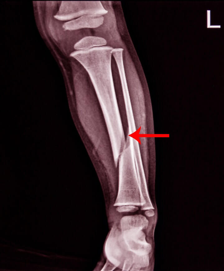 X-Ray of Oblique Fracture